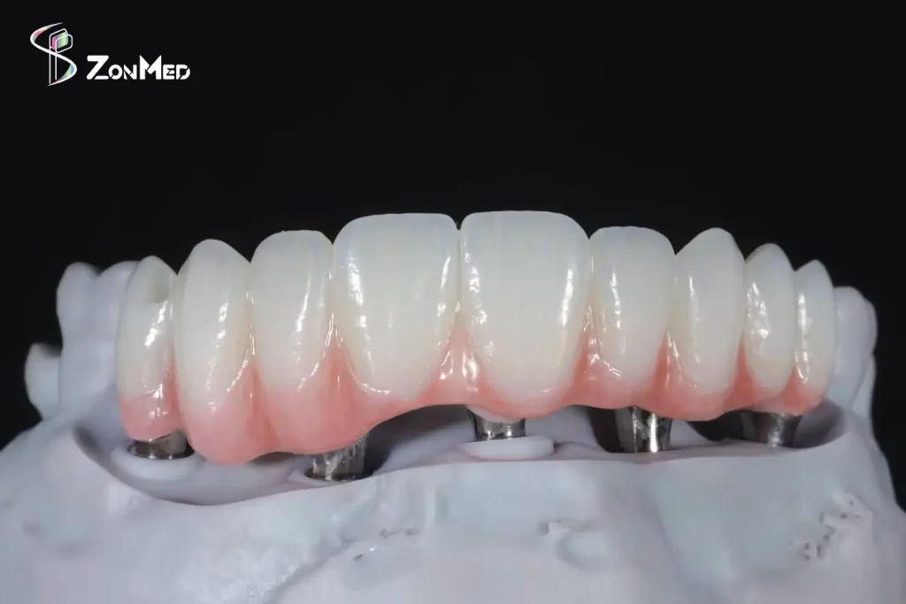 Zonmed Low-Temperature Sintered Ceramic Implant Bridge - Full-Arch Zirconia Restoration on Model