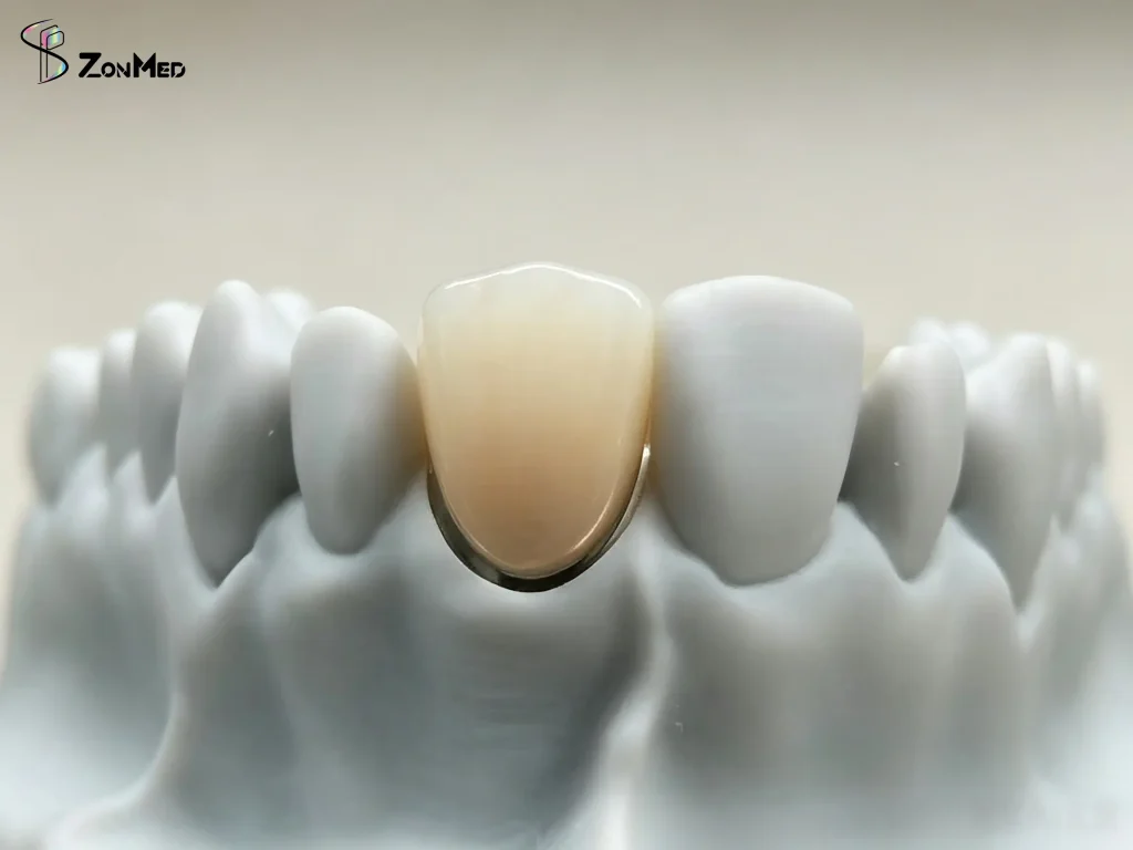 Zonmed Low-Temperature Sintered Pressable Ceramic / Glass Ceramic Crown - Aesthetic Dental Restoration on Model
