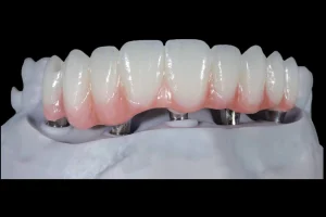 Zonmed dental staining system full-arch ceramic restoration before and after aesthetic comparison