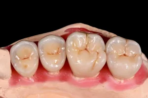 Zonmed dental ceramic staining comparison showing posterior teeth characterization and occlusal staining results