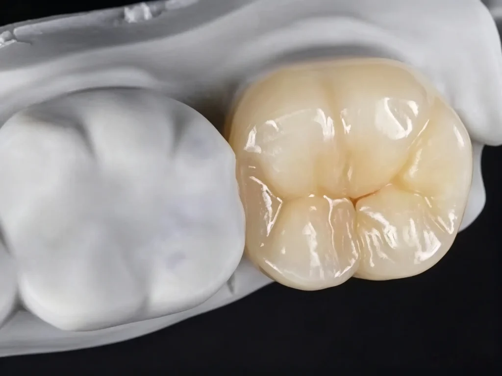 Zonmed Glass Ceramic Restoration Before and After Staining and Glazing