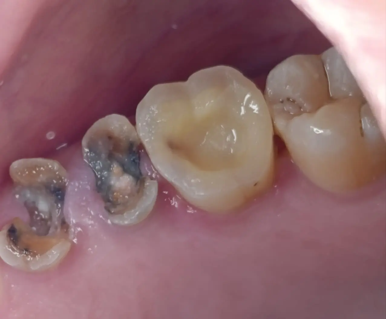 Preoperative Intraoral Condition: Extensive Defect of Upper Right First Molar