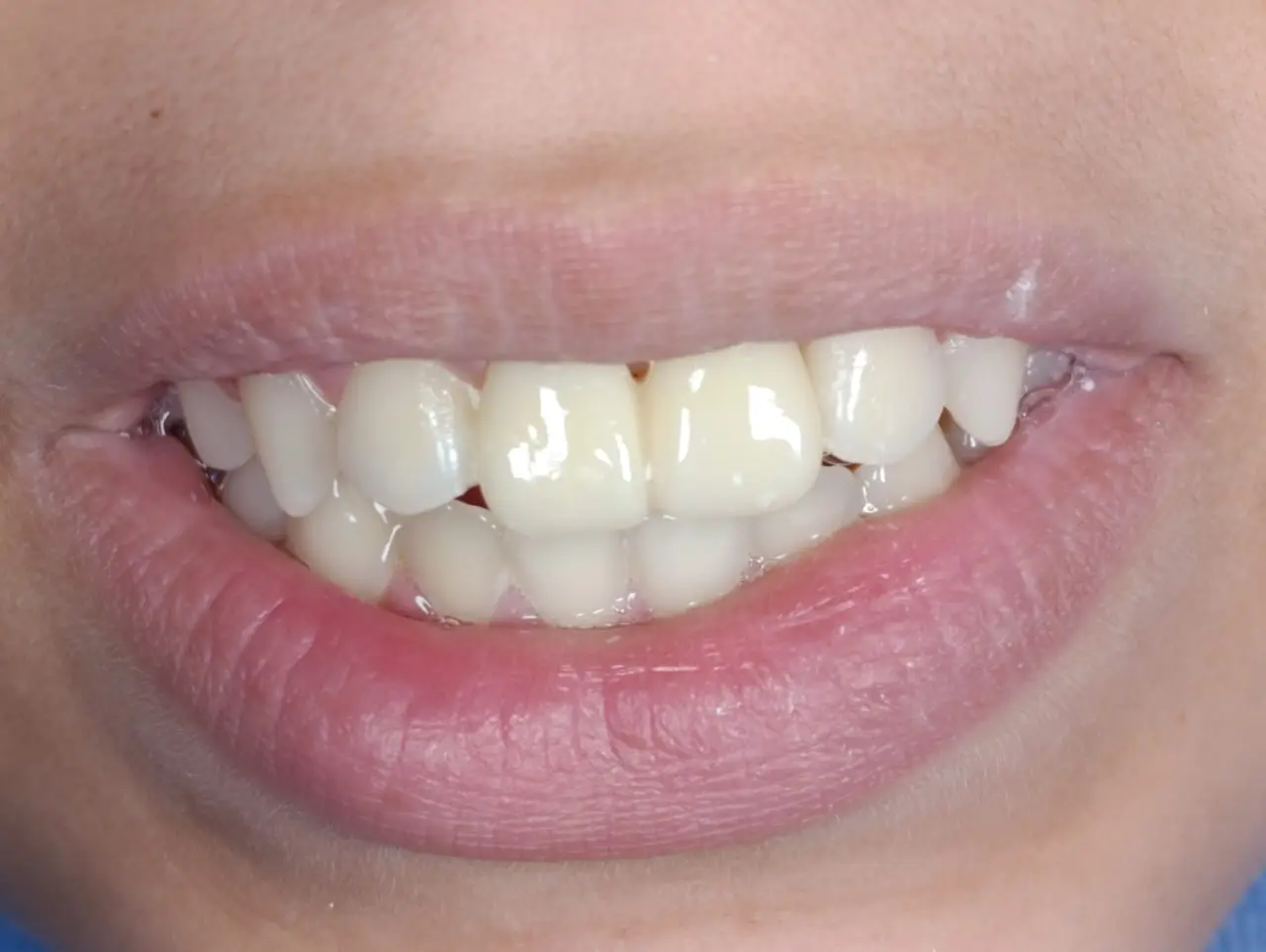 Final Restoration Intraoral Effect